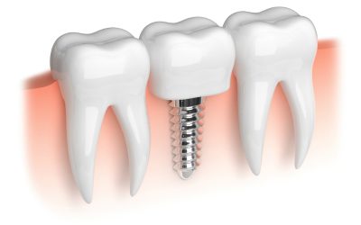 Enhance Your Smile with Centreville Cosmetic Dentistry Services