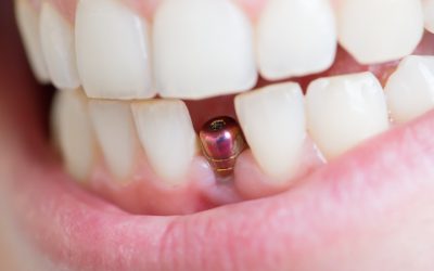 Enhance Your Smile with Expert Tooth Crowns Baton Rouge LA Residents Rely On